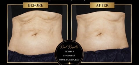 Before and after comparison of abdominal area showing tighter, smoother, more contoured skin results