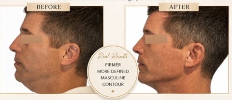 Before and after side profile comparison showing jawline enhancement with firmer, more defined masculine contour