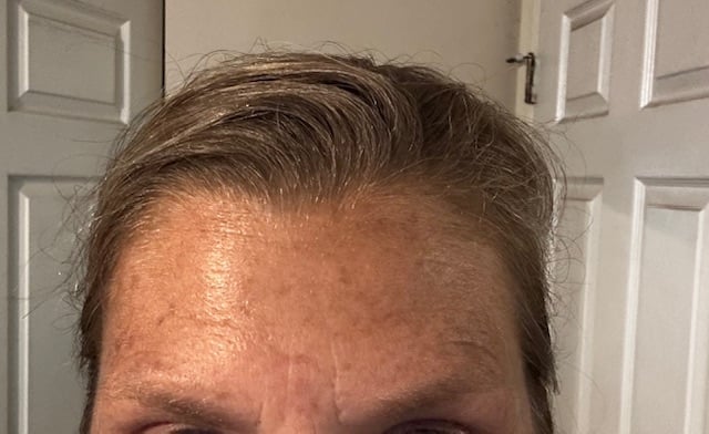 Close-up of a persons forehead and upper face showing flushed or irritated skin, with brown hair pulled back against a white wall background