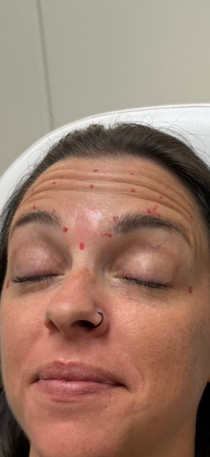 Persons face with closed eyes showing acne and red blemishes on forehead and between eyebrows