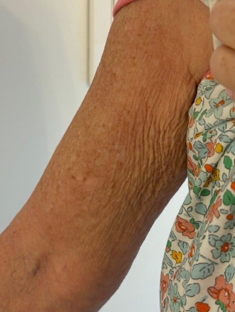 Closeup of an older adults arm showing wrinkled, sun-spotted skin texture against a white background