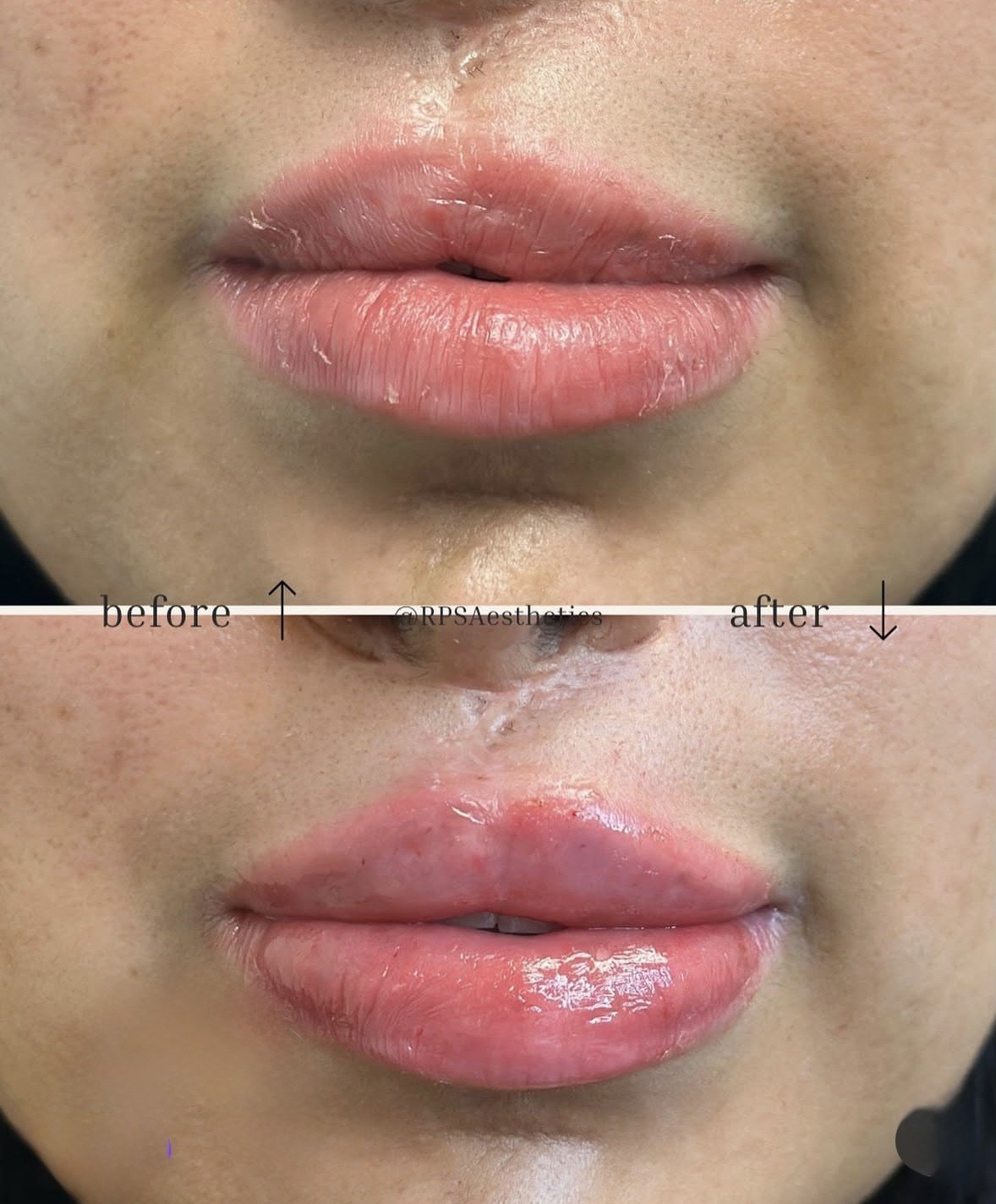 Before and after comparison of lip augmentation treatment showing fuller, more defined lips in the after photo